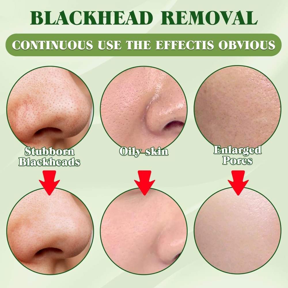 15 Pack Blackhead Remover Nose - Charcoal Pore Strip 评论和价格